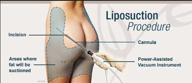 Poder quirúrgico de la máquina del Liposuction de las nalgas del alto vacío ayudado para el hospital