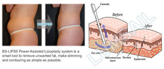 Cavitación del Liposuction que adelgaza el poder de la máquina ayudado