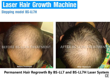 Terapia baja del laser para el crecimiento del pelo