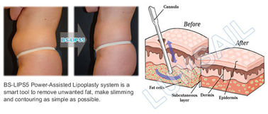 Cuerpo que forma la máquina de la cavitación de la lipolisis del liposuction de la máquina