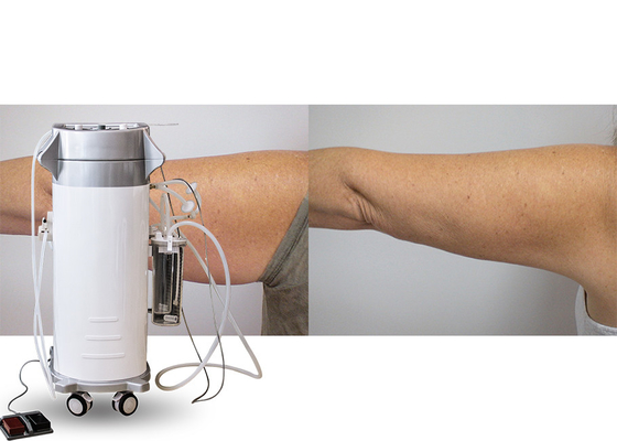 El poder ayudó a la máquina quirúrgica de la cavitación del Liposuction del vacío para los muslos/los brazos/el tratamiento trasero