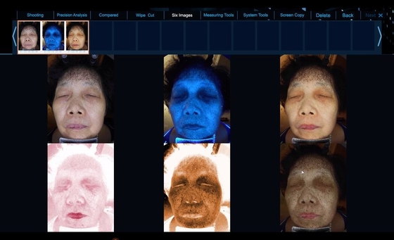 El espectro 6 considera un equipo facial más claro del análisis de la piel del problema de piel