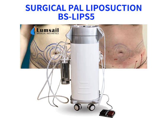 El poder de BS-LIPS5 300W ayudó al equipo del Liposuction para el pecho y Chin del cuello