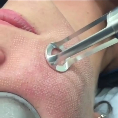 Máquina quirúrgica del laser de la cicatriz del acné fraccionario portátil del CO2 15w