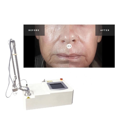 Máquina quirúrgica del laser de la cicatriz del acné fraccionario portátil del CO2 15w